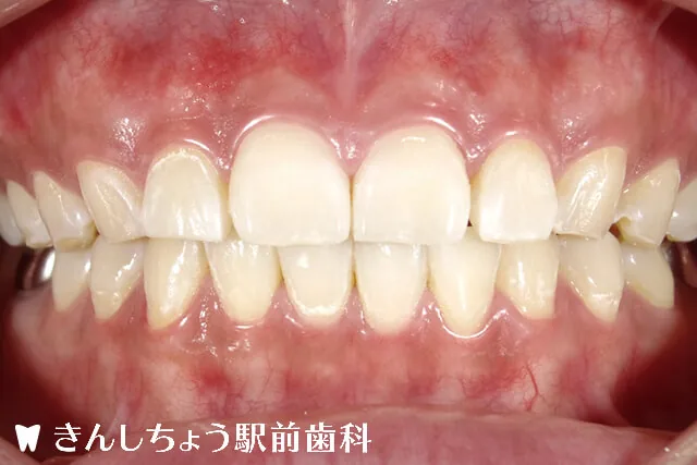 症例写真 after