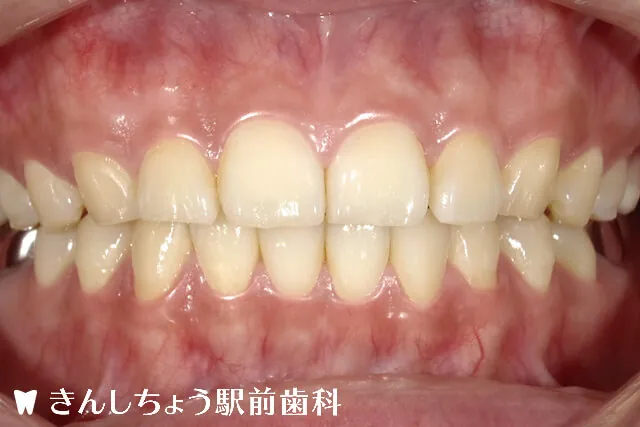 症例写真 Before